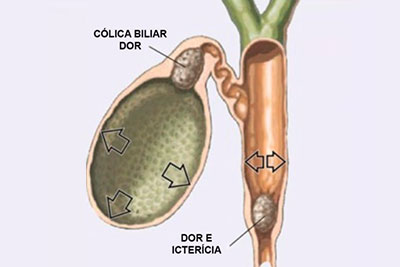 Cirurgia Cólica Biliar