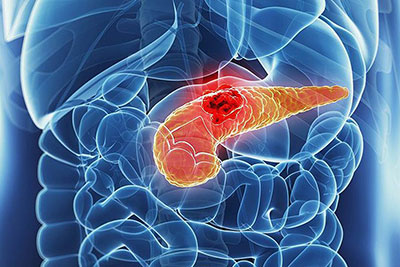 Cirurgia de Câncer de Pâncreas