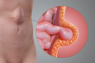 Cirurgia Hérnia Incisional