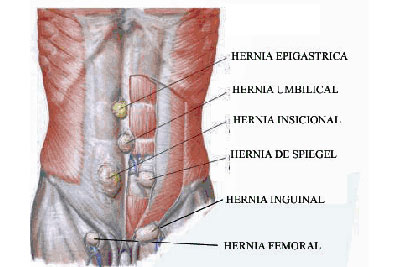 Cirurgia Hérnia Incisional