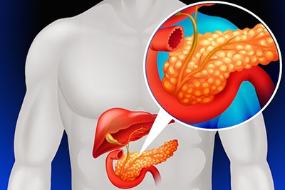 Cirurgia Pancreatite