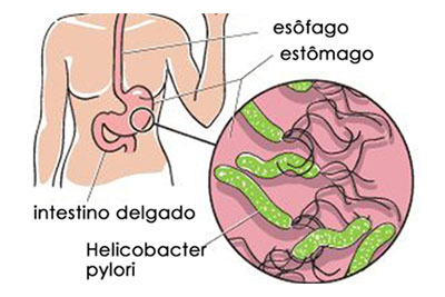 Tratamento de H. pylori